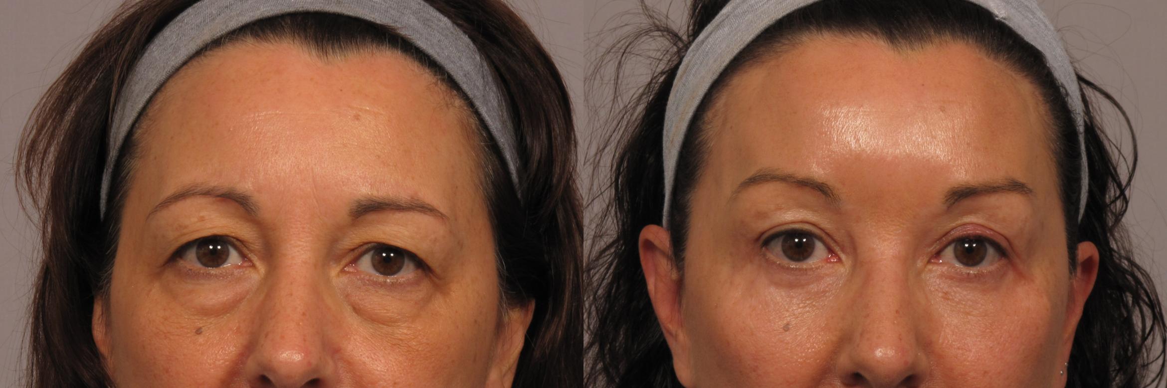 Before and after blepharoplasty performed by Dr Anthony Maloof - Oculoplastic surgeon Sydney