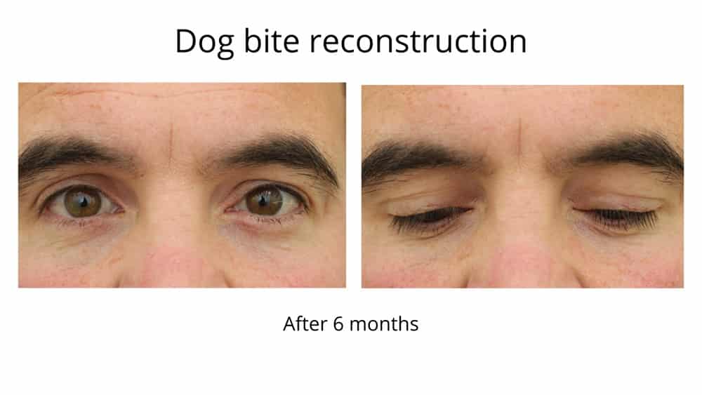 This dog bite reconstruction was performed by Dr Anthony Maloof, Oculoplastic surgeon in Sydney. This shows the result with the eyes open and closed 6 months after surgery.