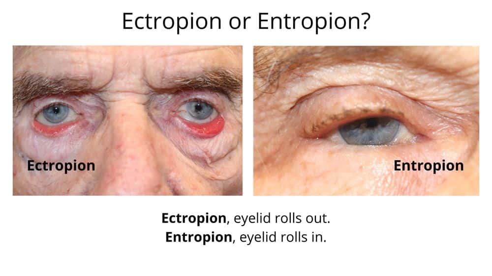 These images show the difference between Ectropion and Entropion. On the right, an ectropion with the lower eyelids rolling out and on the left an Entropion with the eyelids rolling in.