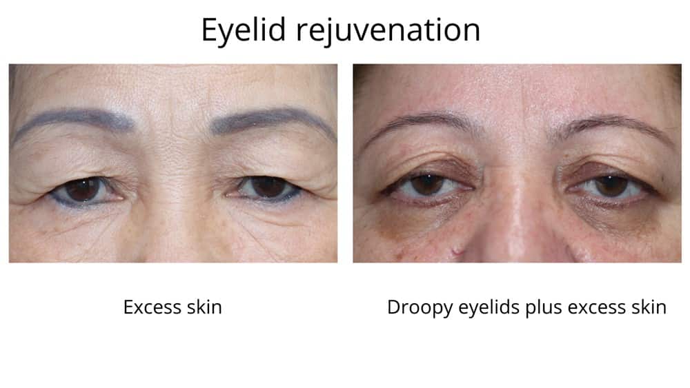 These images show two different eyelid conditions requiring eyelid rejuvenation through oculoplastic surgery. Image 1 shows excess skin causing hooding and image 2 shows droopy eyelids plus excess skin. 