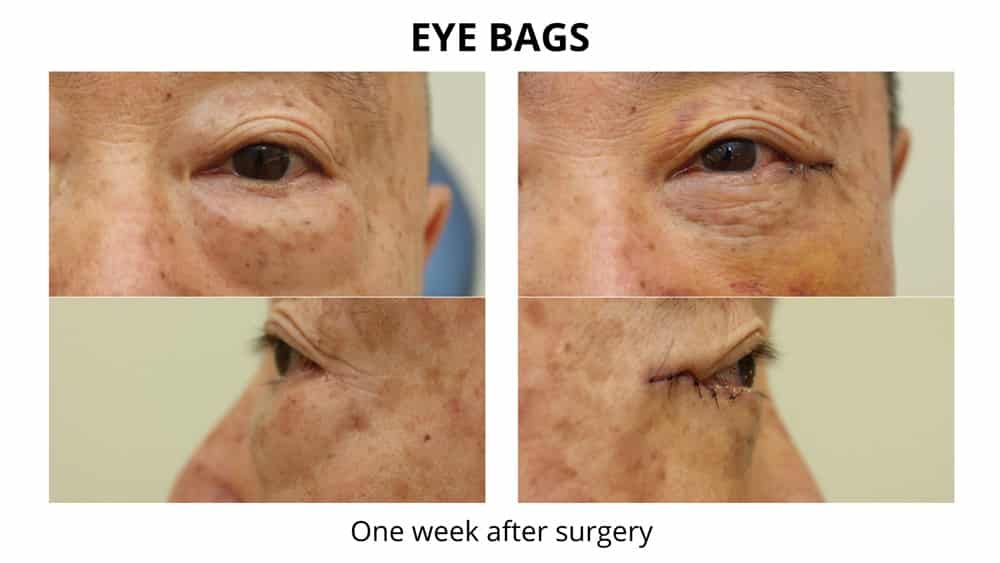 This before and after photo set shows a man with eye bags and the appearance one week after oculoplastic surgery by Dr Maloof Sydney. The after photos clearly show a reduction and you can still see some bruising which is normal.