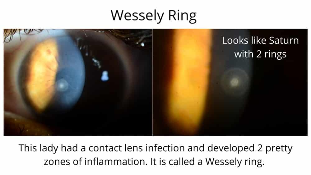 This lady had a contact lens infection and developed 2 pretty zones of inflammation. The rings you can see in each image is called a Wessely ring.