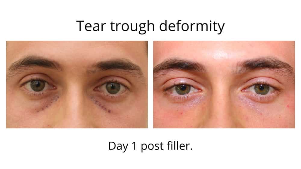 Before and after images of a tear trough deformity. The second photo is one day post filler from Dr Anthony Maloof Sydney.