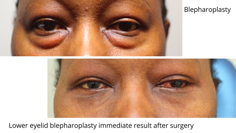 Image depicting before and after results of Blepharoplasty performed by Oculoplastic surgeon, Dr Anthony Maloof. This lower eyelid blepharoplasty shows the result immediately after surgery with no scarring visible. 