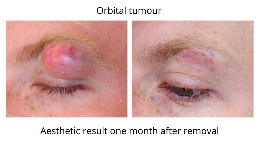 Oculoplastic surgery covers many types of surgery. Here we see an orbital tumour which is quite large above the eyelid. The second photo shows the aesthetic result after oculoplastic surgery by Dr Anthony Maloof in Sydney.