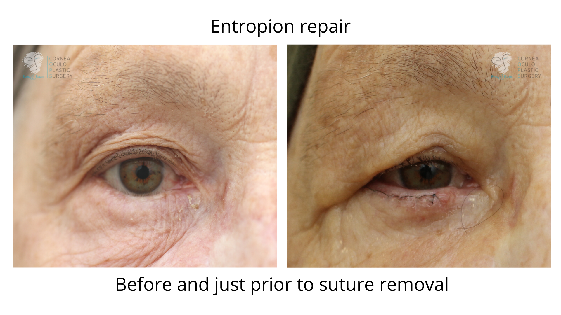 Before and after image of Entropion repair.