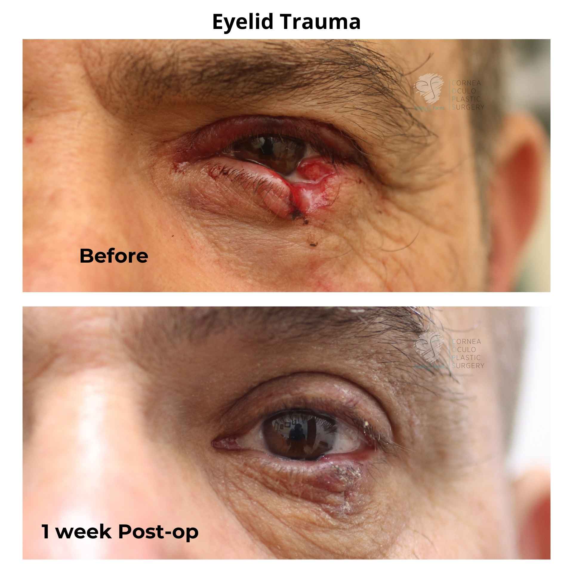 Before and after photo of eyelid trauma. After photo is at 1 week post operatively after Dr Anthony Maloof performed a repair.