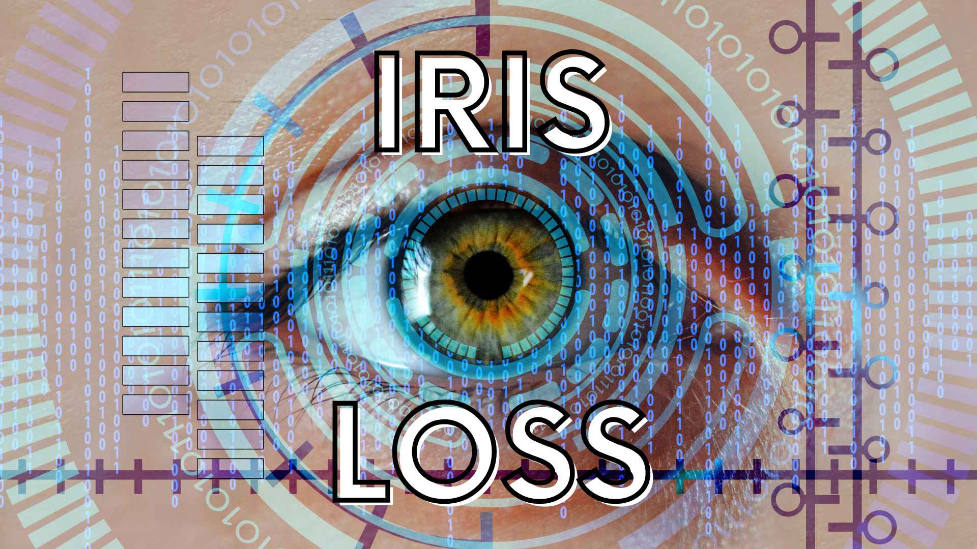 Iris loss by Dr Anthony Maloof, Sydney.