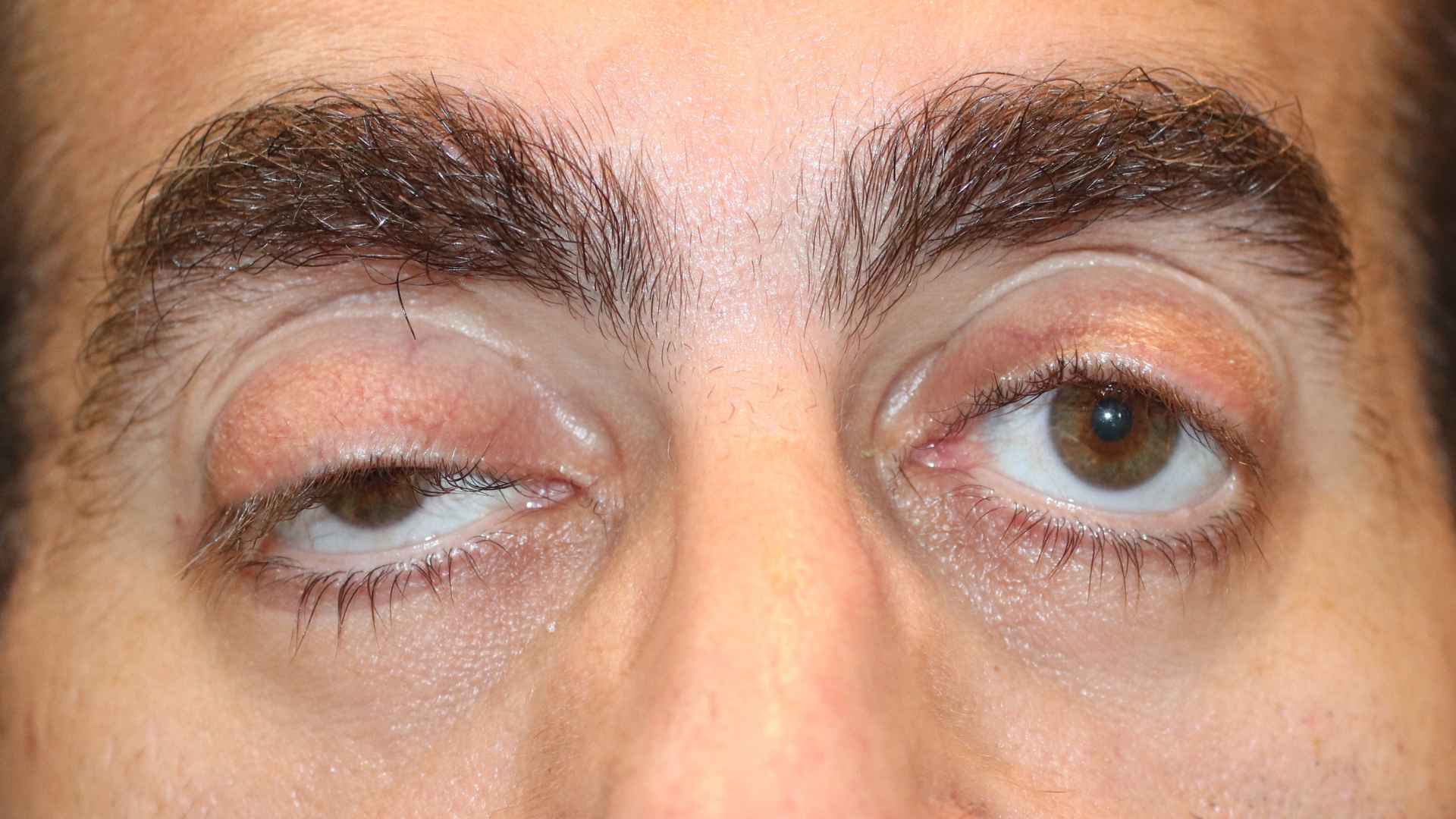 ptosis on one side requiring surgery by Dr Anthony Maloof.