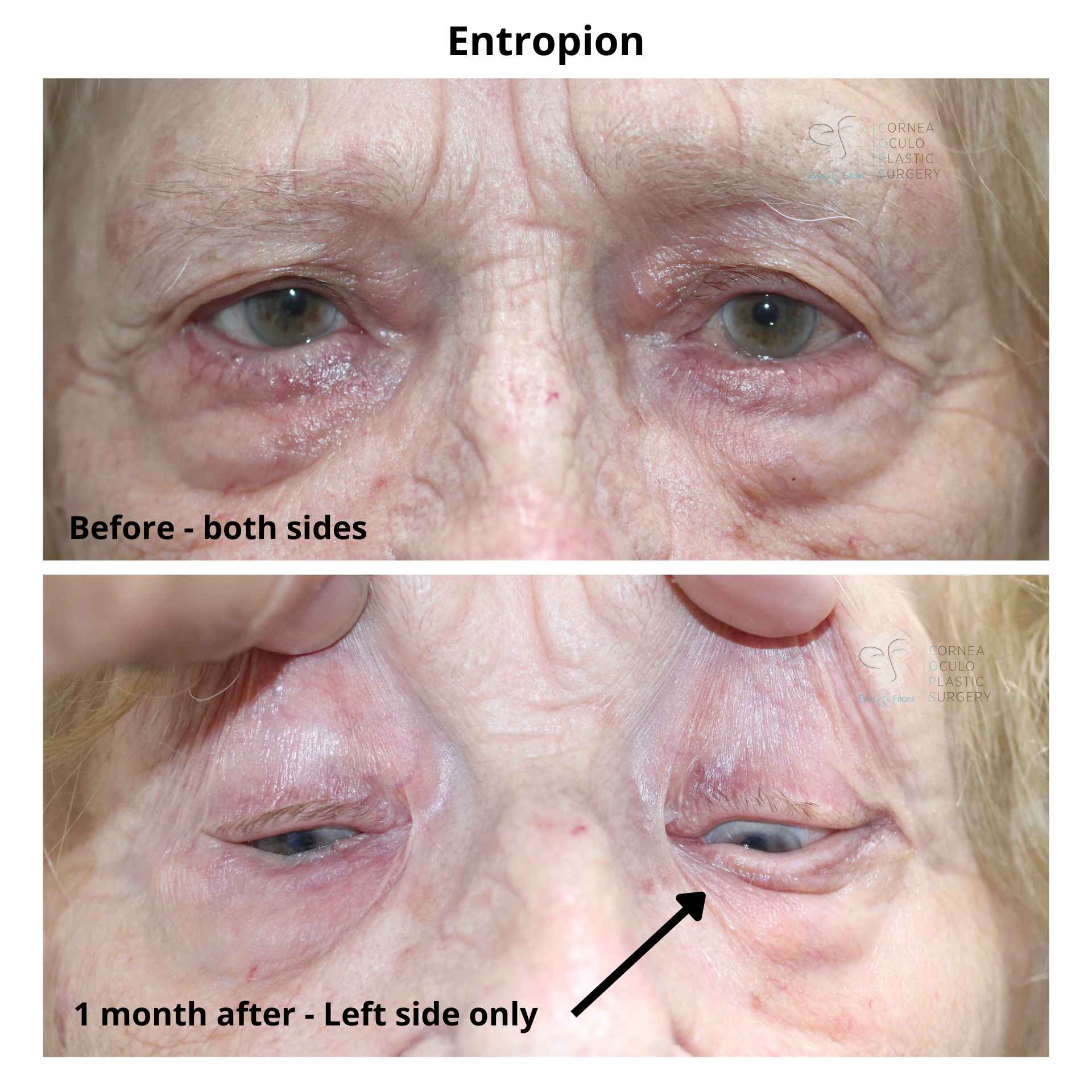 Before and after entropion repair - Dr Anthony Maloof.