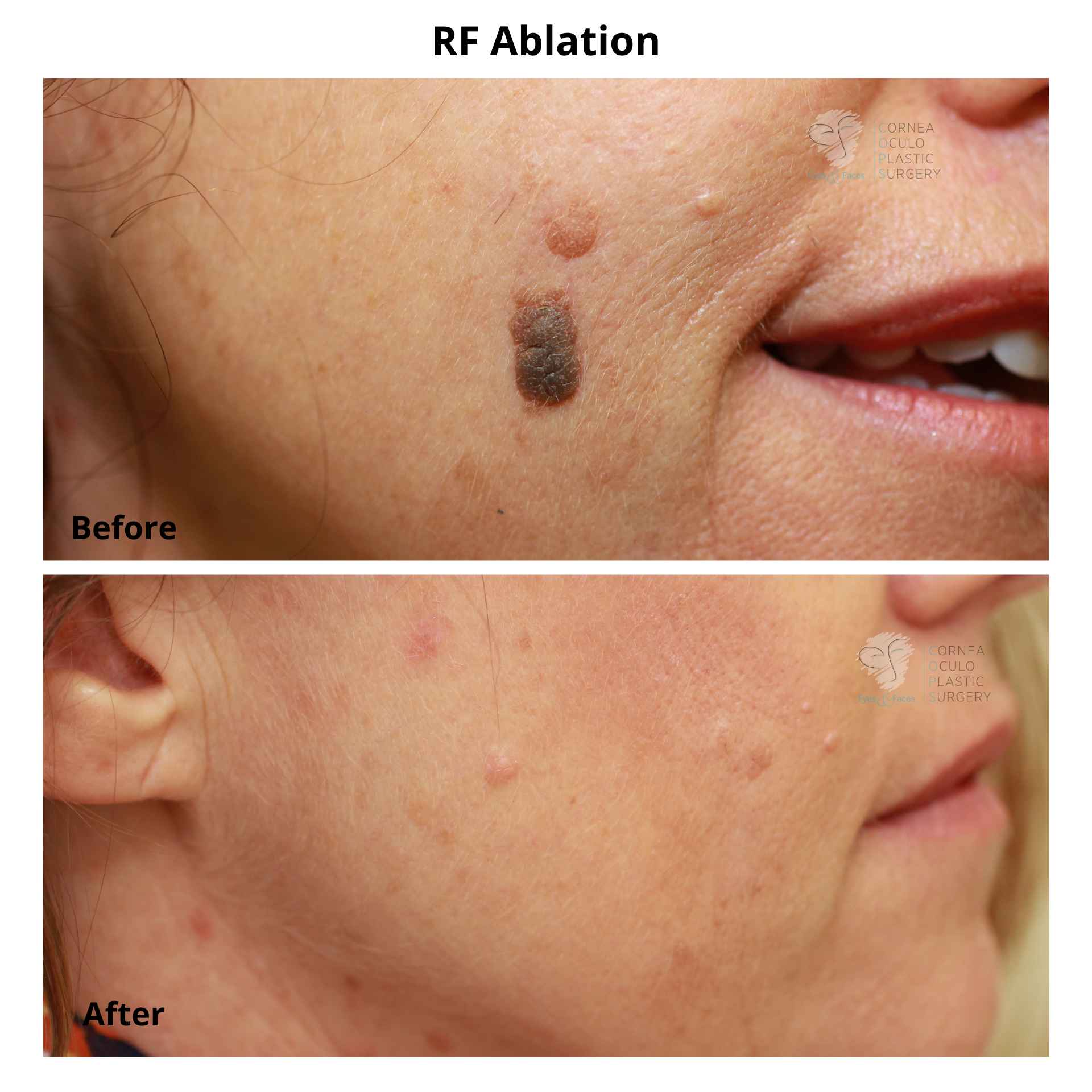 RF Ablation. Before and after nonsurgical removal of facial skin lesion.