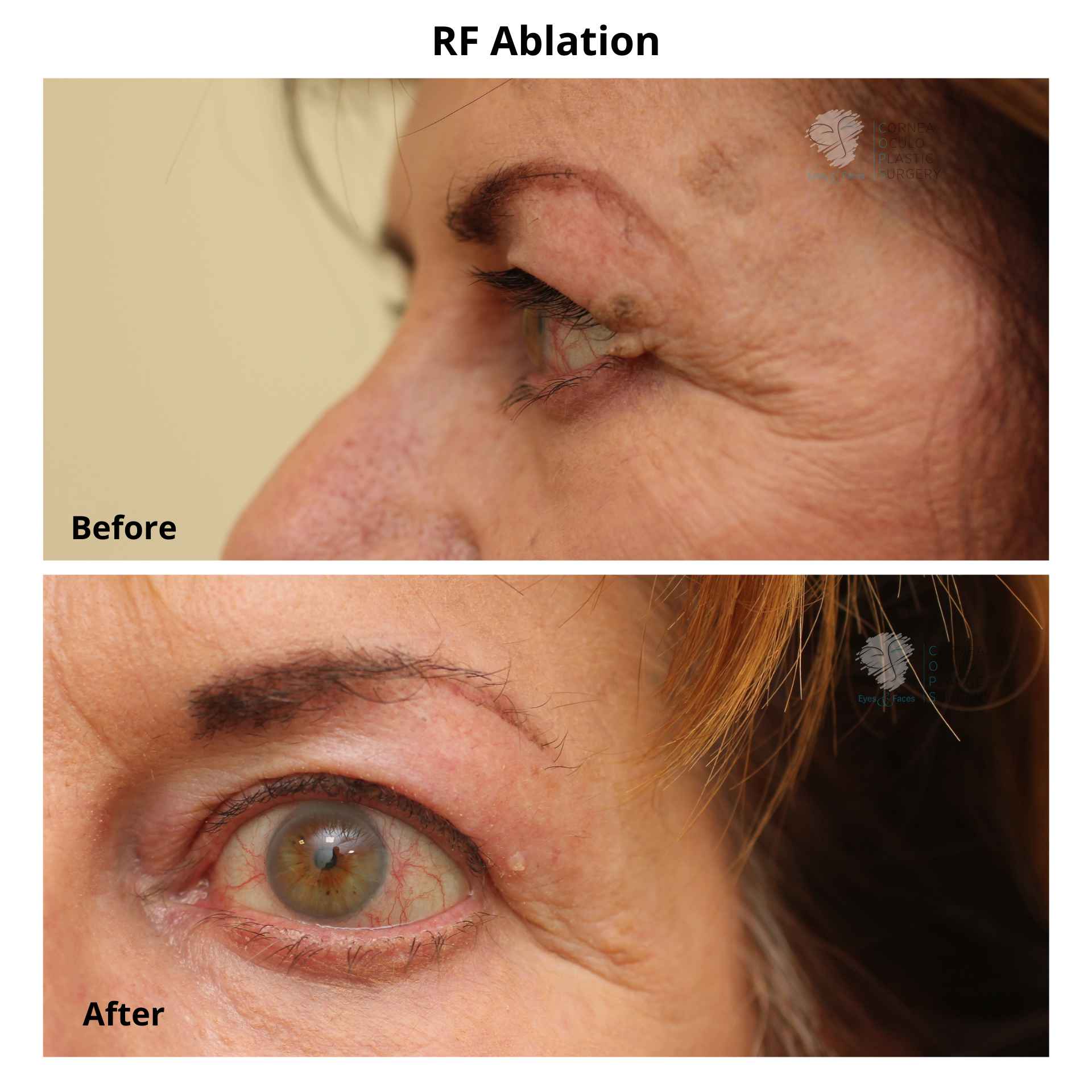 RF Ablation. Before and after nonsurgical removal of facial skin lesion.