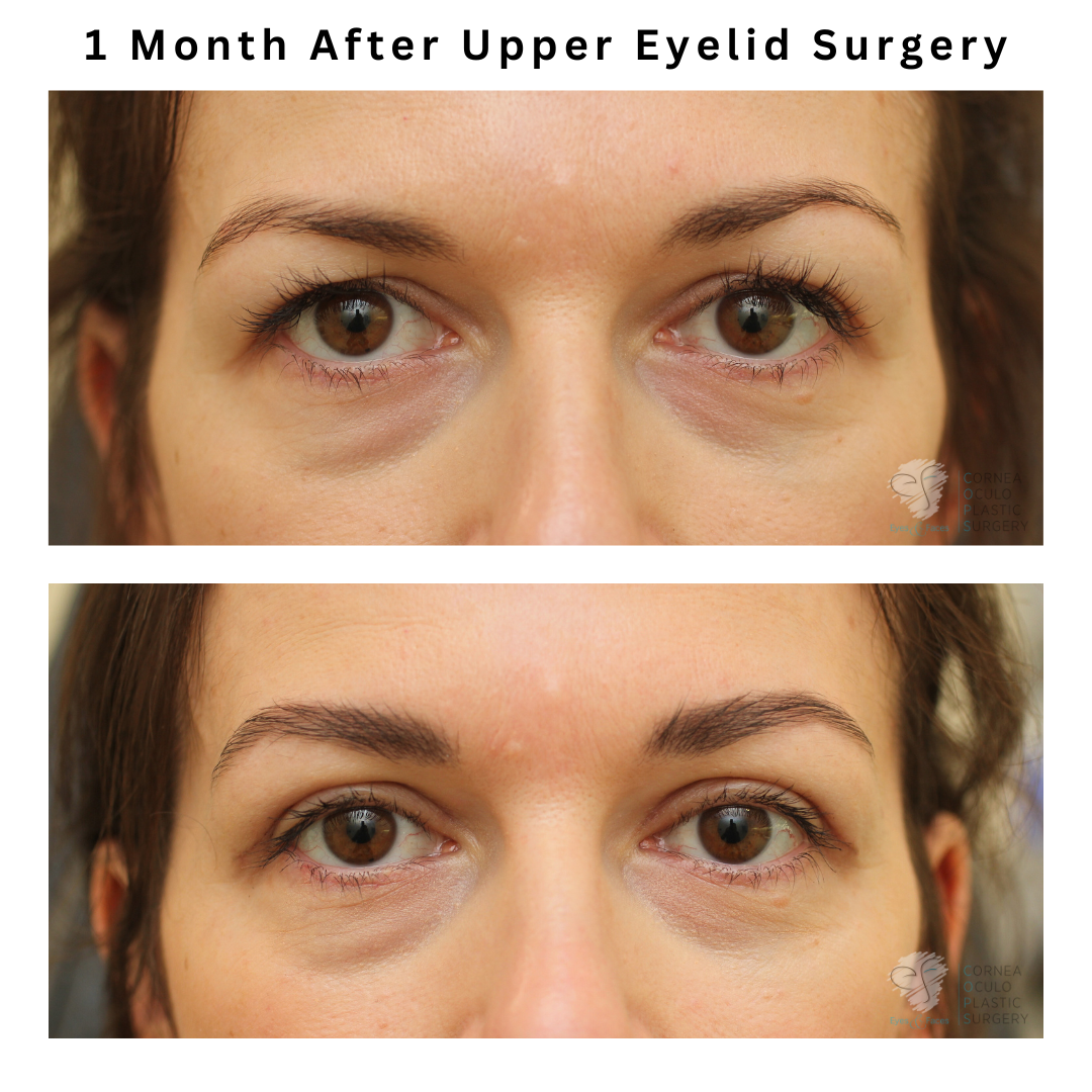 Before and after of upper eyelid surgery or blepharoplasty performed by Dr Anthony Maloof in Sydney.