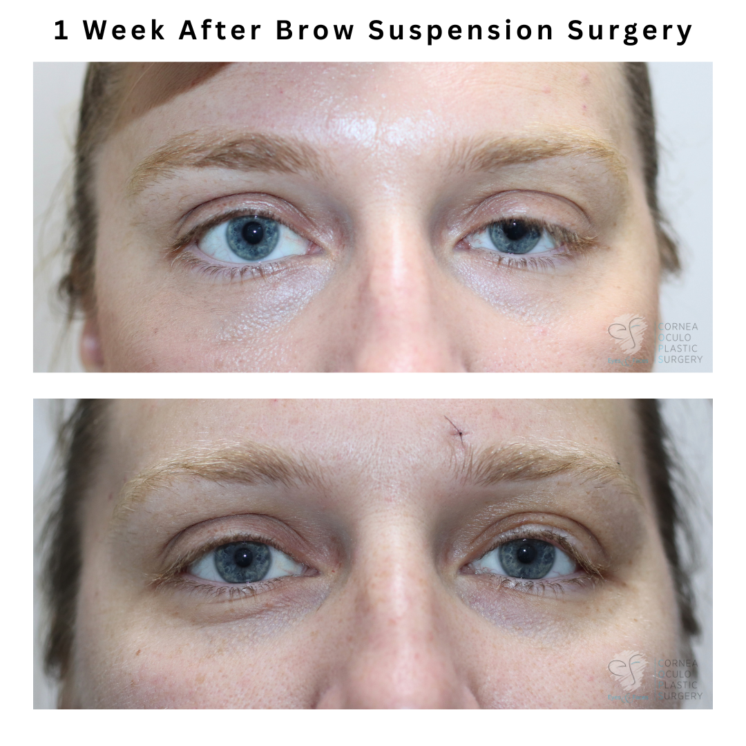 Before and 1 week after Brow lift by Dr Anthony Maloof in Sydney