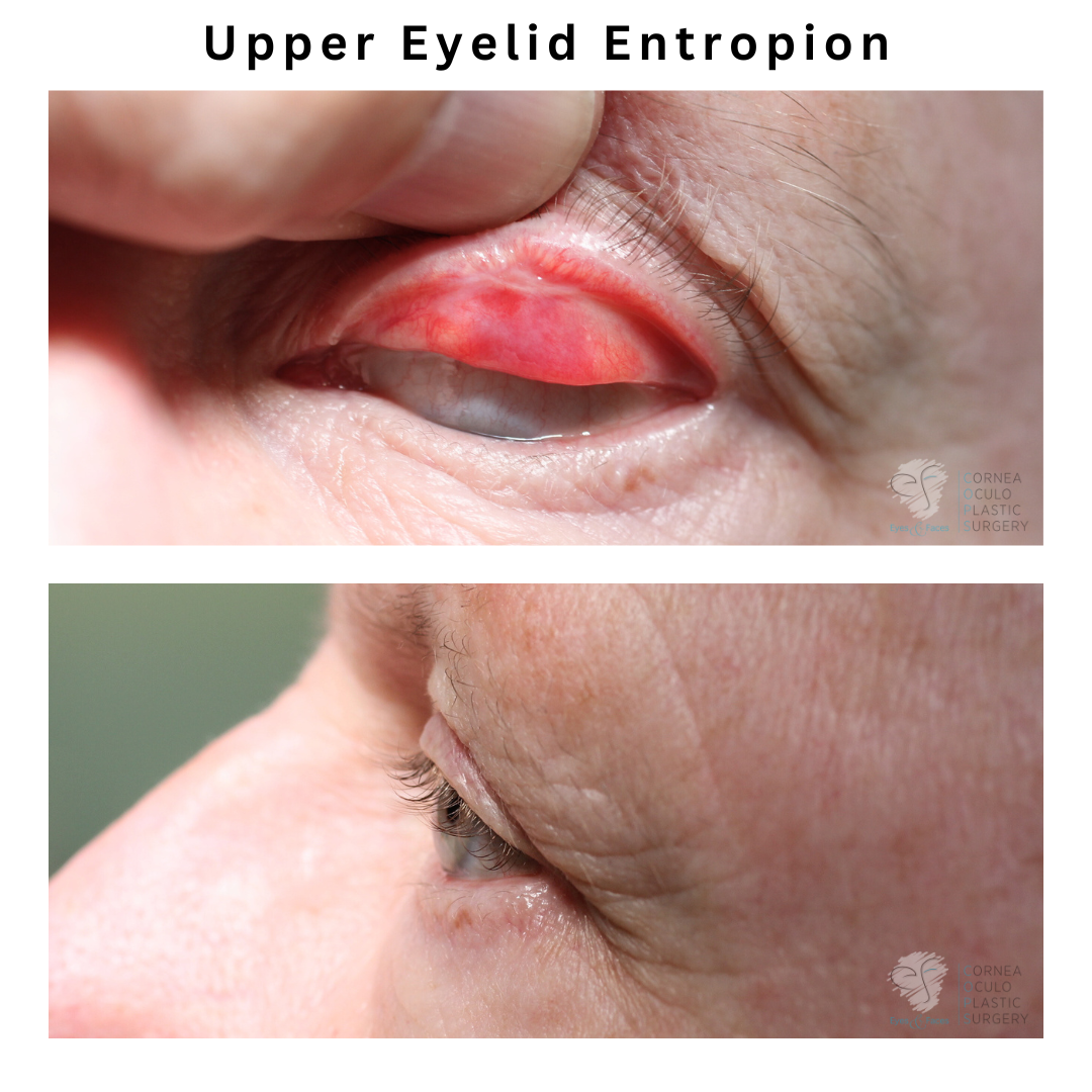 Upper eyelid entropion performed by Dr Anthony Maloof - Sydney