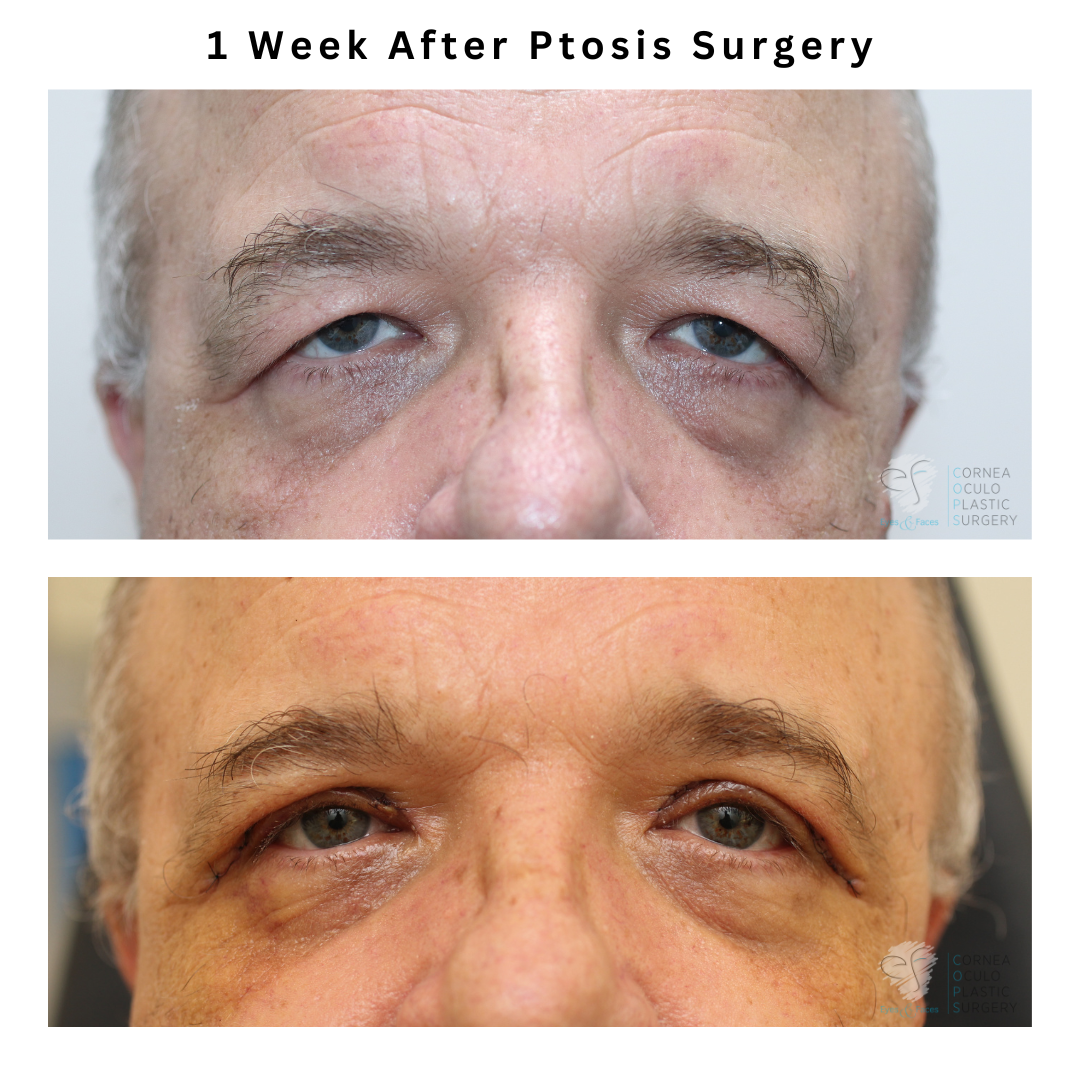 Before and after ptosis or eyelid surgery performed by Dr Anthony Maloof in Sydney